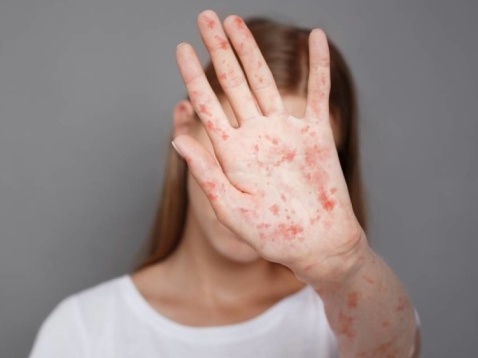 У Молдові в центрі розміщення біженців з України зафіксували спалах кору